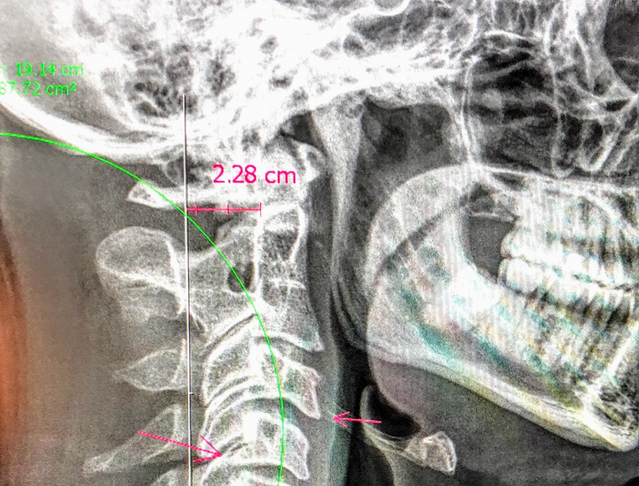 An x-ray of the side of my head, showing the bottom of my skull, the jaw, and some neck vertebrae.